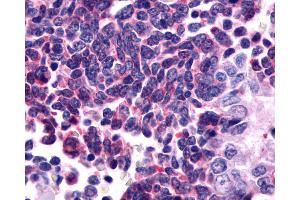 Anti-GPR162 antibody IHC of human Lung, Small Cell Carcinoma. (GPR162 Antikörper  (Extracellular Domain))