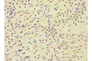 Immunohistochemistry of paraffin-embedded human breast cancer using ABIN7159821 at dilution of 1:100 (MCMBP Antikörper  (AA 1-240))