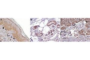 Expression of MC1R in normal skin and melanoma - Immunohistochemical staining of paraffin embedded normal skin and melanoma sections using Anti-MC1 Receptor Antibody (ABIN7043321, ABIN7044592 and ABIN7044593) (1:100). (MC1 Receptor Antikörper  (AA 217-232))