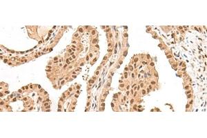 Immunohistochemistry of paraffin-embedded Human thyroid cancer tissue using LGALS4 Polyclonal Antibody at dilution of 1:30(x200) (GAL4 Antikörper)