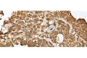 Immunohistochemistry of paraffin-embedded Human ovarian cancer tissue using RBL2 Polyclonal Antibody at dilution of 1:45(x200) (p130 Antikörper)