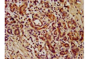 IHC image of ABIN7172763 diluted at 1:1000 and staining in paraffin-embedded human pancreatic cancer performed on a Leica BondTM system. (TEAD3 Antikörper  (AA 112-435))