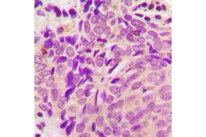 Immunohistochemical analysis of Beta-tubulin staining in human breast cancer formalin fixed paraffin embedded tissue section. (TUBB Antikörper  (C-Term))