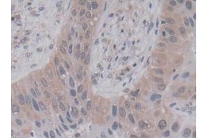 DAB staining on IHC-P; Samples: Human Lung cancer Tissue (PPIA Antikörper  (AA 2-165))