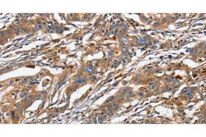 Immunohistochemistry of paraffin-embedded Human gastric cancer using GNA13 Polyclonal Antibody at dilution of 1:30 (GNA13 Antikörper)