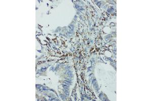 Anti-integrin beta 4 binding protein antibody, IHC(P) IHC(P): Human Intestinal Cancer Tissue (EIF6 Antikörper  (Middle Region))