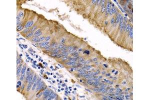 Immunohistochemistry of paraffin-embedded Human colon cancer using IL9 Polyclonal Antibody at dilution of 1:200 (40x lens). (IL-9 Antikörper)