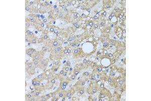Immunohistochemistry of paraffin-embedded human liver injury using AARS2 antibody. (AARS2 Antikörper)