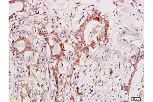 Formalin-fixed and paraffin embedded human breast cancer labeled with Anti-CA153/MUC1/KL-6 Polyclonal Antibody, Unconjugated (ABIN687367) at 1:200 followed by conjugation to the secondary antibody and DAB staining. (MUC1 Antikörper  (AA 1101-1255))