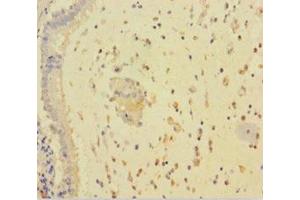 Immunohistochemistry of paraffin-embedded human lung cancer using ABIN7167811 at dilution of 1:100 (RARRES3 Antikörper  (AA 1-133))