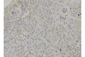ABIN6272856 at 1/100 staining Human breast cancer tissue by IHC-P. (Caprin-1 Antikörper  (Internal Region))