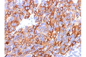 Formalin-fixed, paraffin-embedded human Melanoma stained with MART-1 / Melan-A Monoclonal Antibody (A103+M2-7C10+M2-9E3). (MLANA Antikörper)
