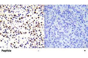Immunohistochemical analysis of paraffin-embedded human malignant lymphoma tissue using HIST1H3E (phospho T3) polyclonal antibody . (HIST1H3E Antikörper  (pThr3))