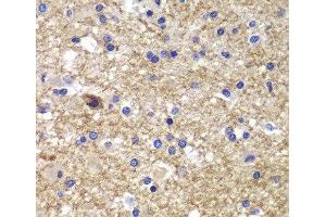 Immunohistochemistry of paraffin-embedded Human brain cancer using CDK6 Polyclonal Antibody at dilution of 1:100 (40x lens). (CDK6 Antikörper)