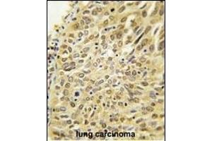 Formalin-fixed and paraffin-embedded human lung carcinoma tissue reacted with Dsk2 Antibody (N-term) (ABIN388963 and ABIN2839210) , which was peroxidase-conjugated to the secondary antibody, followed by DAB staining.