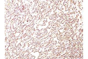 Formalin-fixed, paraffin-embedded human Angiosarcoma stained with Podocalyxin Monoclonal Antibody (4F10). (PODXL Antikörper  (Extracellular Domain))