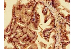 Immunohistochemistry of paraffin-embedded human prostate cancer using ABIN7151962 at dilution of 1:100 (EPN3 Antikörper  (AA 25-208))