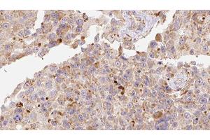 ABIN6278123 at 1/100 staining Human Melanoma tissue by IHC-P. (APOC3 Antikörper  (Internal Region))