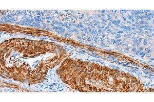Immunohistochemistry of paraffin-embedded Human cervical cancer tissue using AARS Polyclonal Antibody at dilution 1:60 (AARS Antikörper)