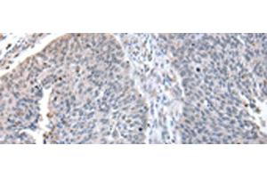 Immunohistochemistry of paraffin-embedded Human lung cancer tissue using ZNF23 Polyclonal Antibody at dilution of 1:50(x200) (ZNF23 Antikörper)