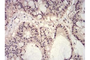 Immunohistochemical analysis of paraffin-embedded colon cancer tissues using HIST2H3C(27Ac) mouse mAb with DAB staining. (Histone Cluster 2, H3c (HIST2H3C) (acLys27) Antikörper)