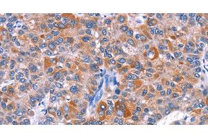 Immunohistochemistry of paraffin-embedded Human liver cancer tissue using ELP2 Polyclonal Antibody at dilution 1:40 (ELP2 Antikörper)