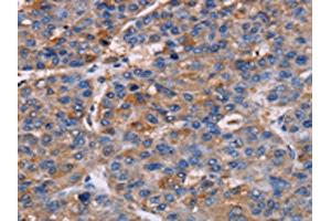 The image on the left is immunohistochemistry of paraffin-embedded Human liver cancer tissue using ABIN7130450(NPM3 Antibody) at dilution 1/60, on the right is treated with fusion protein. (NPM3 Antikörper)