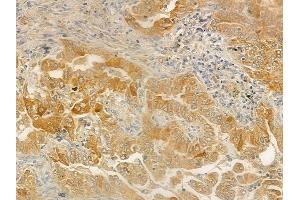 ABIN6259517 and ABIN6275666 at 1/100 staining human lung adenocarcinoma by IHC-P. (UEVLD Antikörper  (N-Term))