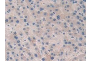 Detection of F5 in Human Liver cancer Tissue using Polyclonal Antibody to Coagulation Factor V (F5) (Coagulation Factor V Antikörper  (AA 463-715))