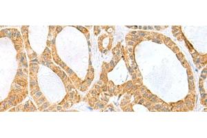 Immunohistochemistry of paraffin-embedded Human thyroid cancer tissue using PPIH Polyclonal Antibody at dilution of 1:60(x200)