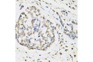 Immunohistochemistry of paraffin-embedded human esophageal cancer using PSMB1 antibody. (PSMB1 Antikörper  (AA 29-241))