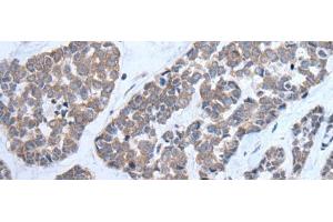 Immunohistochemistry of paraffin-embedded Human esophagus cancer tissue using CNTN1 Polyclonal Antibody at dilution of 1:35(x200) (Contactin 1 Antikörper)
