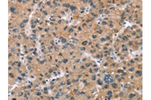 The image on the left is immunohistochemistry of paraffin-embedded Human liver cancer tissue using ABIN7189673(ADGRB2 Antibody) at dilution 1/25, on the right is treated with synthetic peptide. (BAI2 Antikörper)