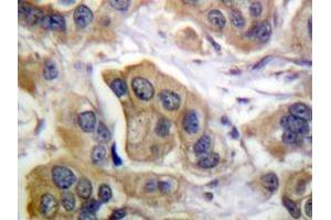 Immunohistochemistry analyzes of ErbB-3 antibody in paraffin-embedded human breast carcinoma tissue. (ERBB3 Antikörper)