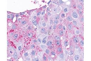 Anti-TAAR9 antibody IHC of human Breast, Carcinoma. (TAAR9 Antikörper  (C-Term))