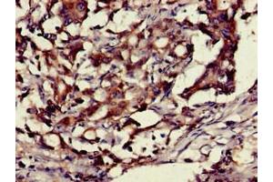 Immunohistochemistry of paraffin-embedded human gastric cancer using ABIN7155201 at dilution of 1:100 (HMGB1 Antikörper  (AA 2-215))