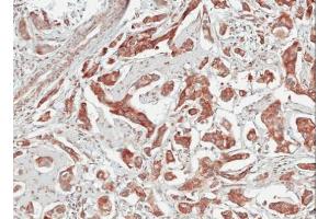 IHC-P Image Immunohistochemical analysis of paraffin-embedded human breast cancer, using TULP1, antibody at 1:100 dilution. (TULP1 Antikörper)