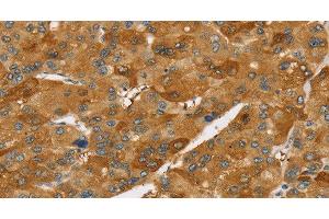 Immunohistochemistry of paraffin-embedded Human liver cancer using TNFSF15 Polyclonal Antibody at dilution of 1:40 (TNFSF15 Antikörper)