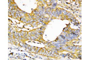 Anti-Caspase-1(P20) antibody, IHC(P) IHC(P): Human Mammary Cancer Tissue (Caspase 1 Antikörper  (N-Term))