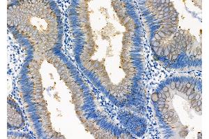 ABIN6261615 and ABIN6273239 at 1/100 staining Human colorectal cancer by IHC-P. (ETFDH Antikörper  (C-Term))