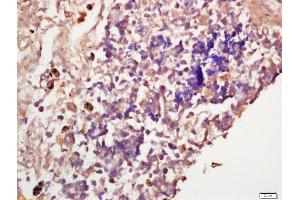 Formalin-fixed and paraffin embedded human lung carcinoma labeled with Anti-IGF2R Polyclonal Antibody, Unconjugated (ABIN719711) at 1:200 followed by conjugation to the secondary antibody and DAB staining