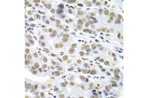 Immunohistochemistry of paraffin-embedded human gastric cancer using HDAC2 antibody (ABIN5971110) at dilution of 1/100 (40x lens). (HDAC2 Antikörper)