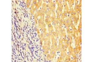 Immunohistochemistry of paraffin-embedded human liver cancer using ABIN7154056 at dilution of 1:100 (GCDH Antikörper  (AA 45-300))