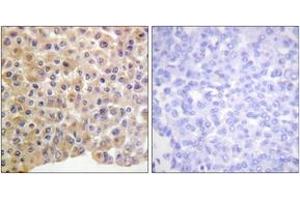 Immunohistochemistry analysis of paraffin-embedded human breast carcinoma, using IR (Phospho-Tyr1361) Antibody. (IR (AA 1331-1380), (pTyr1361) Antikörper)