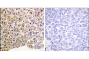 Immunohistochemistry analysis of paraffin-embedded human breast carcinoma, using IR (Phospho-Tyr1361) Antibody. (IR (AA 1331-1380), (pTyr1361) Antikörper)