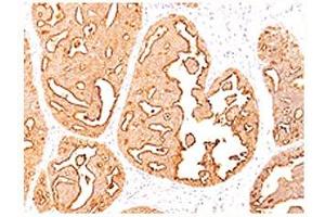 Epithelial Marker Antigen antibody IHC testing of formalin-paraffin human breast cancer tissue.
