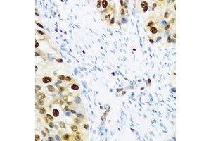 Immunohistochemical analysis of SLM-1 staining in human prostate cancer formalin fixed paraffin embedded tissue section.
