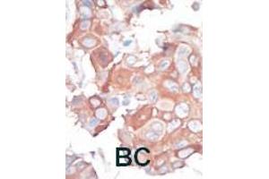 Formalin-fixed and paraffin-embedded human cancer tissue reacted with the primary antibody, which was peroxidase-conjugated to the secondary antibody, followed by AEC staining. (MAP3K1 Antikörper  (C-Term))