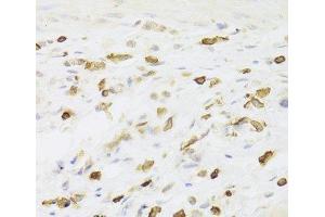 Immunohistochemistry of paraffin-embedded Human gastric cancer using LSP1 Polyclonal Antibody at dilution of 1:100 (40x lens). (LSP1 Antikörper)
