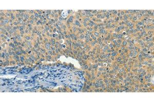 Immunohistochemistry of paraffin-embedded Human cervical cancer tissue using BCAT1 Polyclonal Antibody at dilution 1:50 (BCAT1 Antikörper)